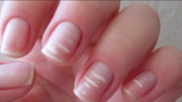 What Your Nails Are Trying To Tell You About Your Health